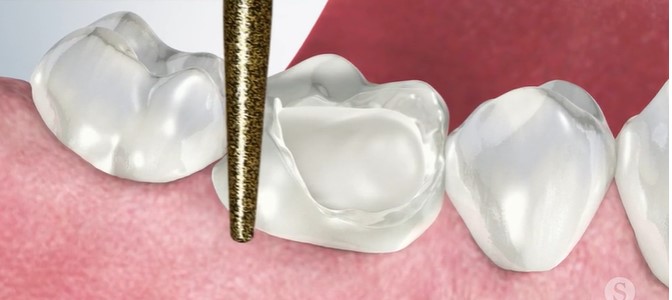 cosmetic-fillings-hartsdale-scarsdale