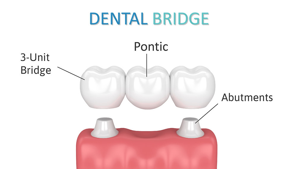 dental-bridge-westchester